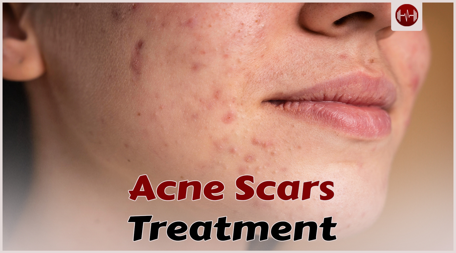 5 effective treatments for acne scar at home