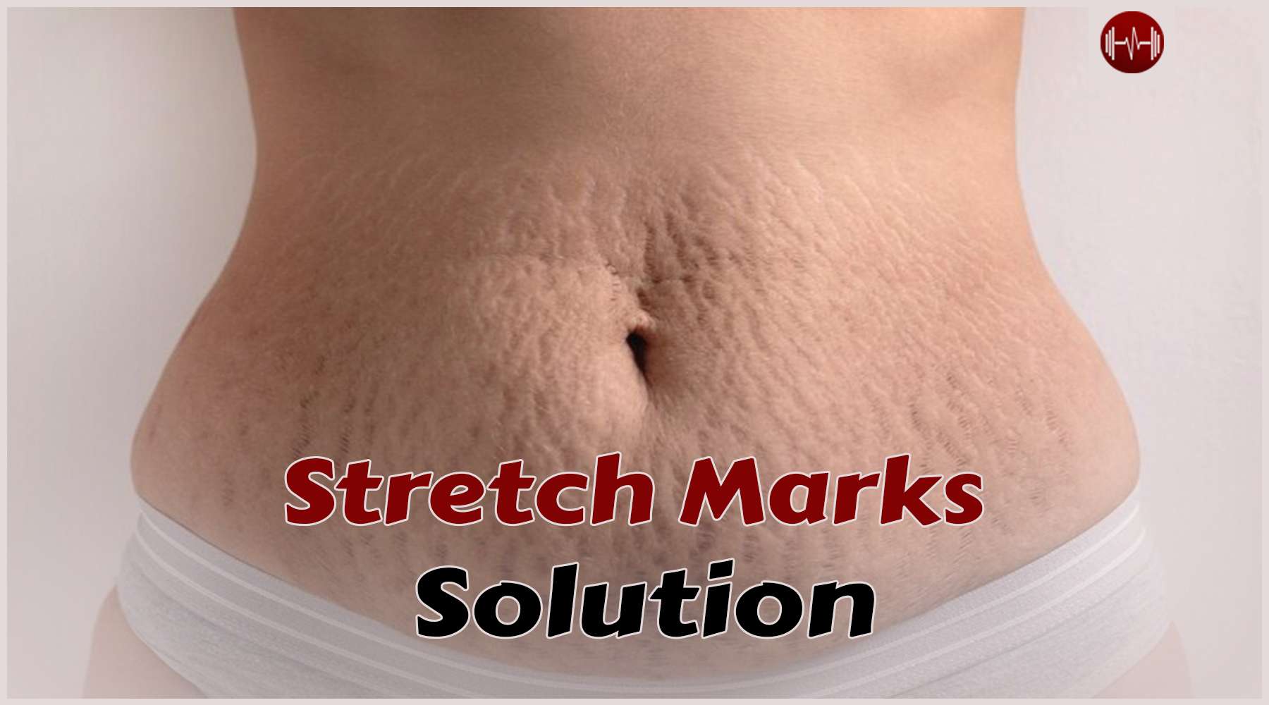 Stretch Marks No More: Embracing Your Body’s Journey