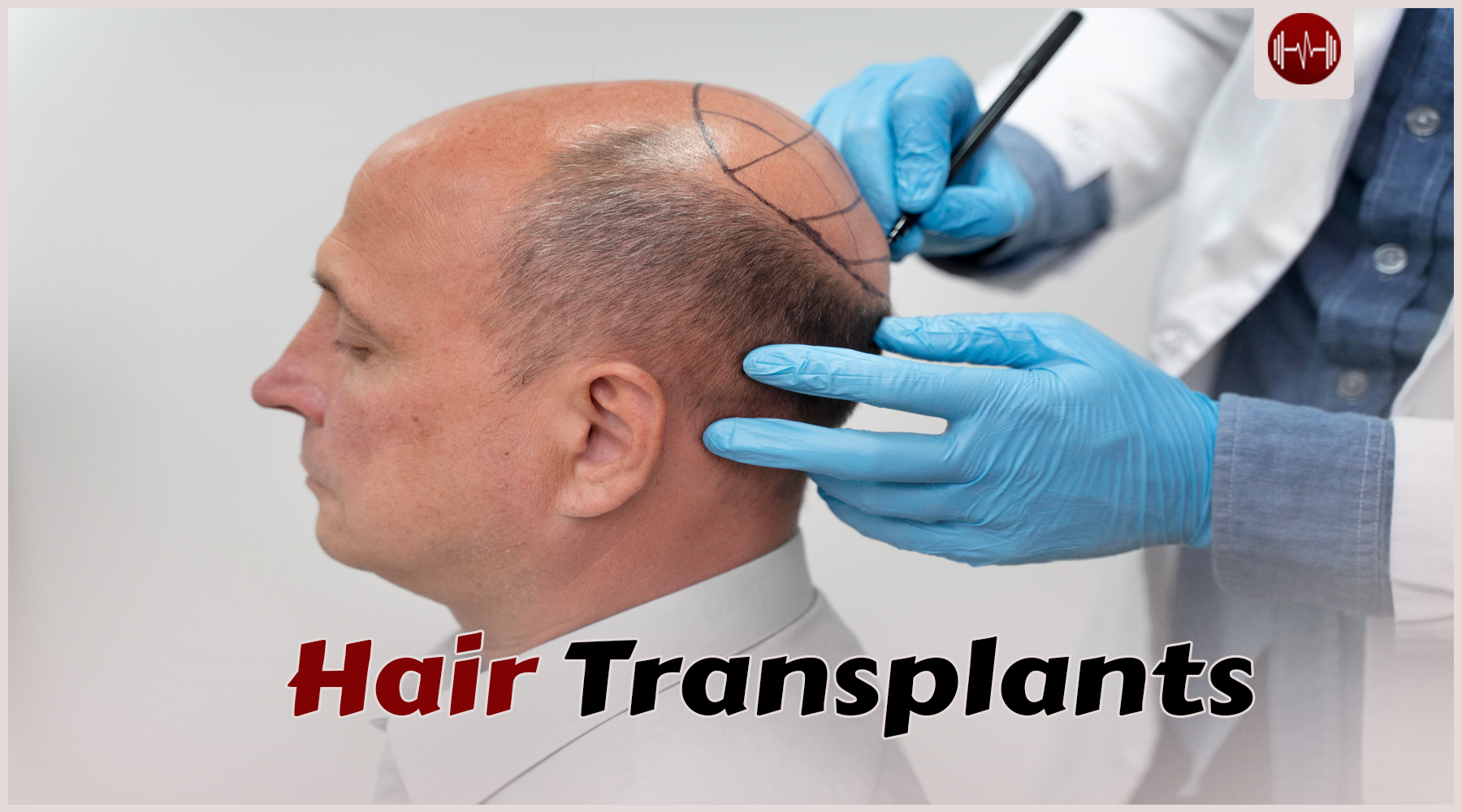 The Guide to Hair Transplants: Costs, Methods & Recovery